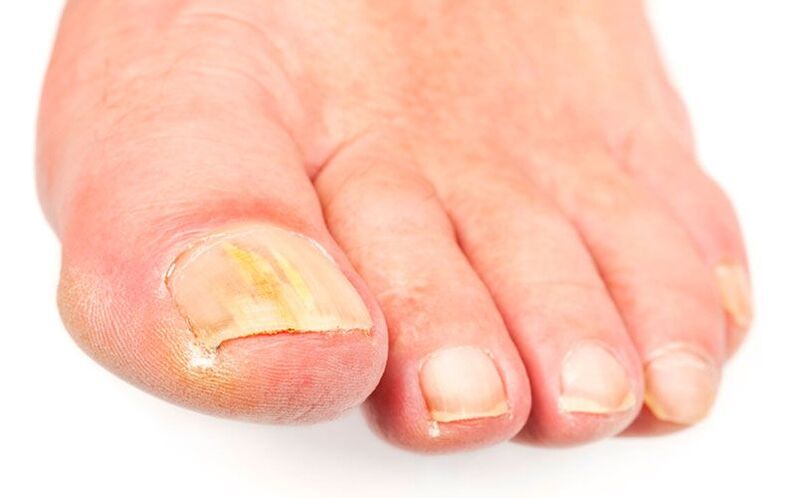 The causes of the fungus