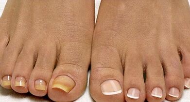 Fleet fungi treatment methods