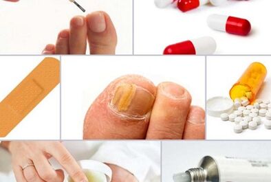 How to treat nail fungus