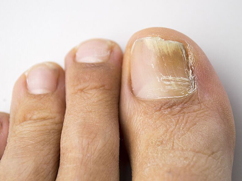 The initial stage of the fungus