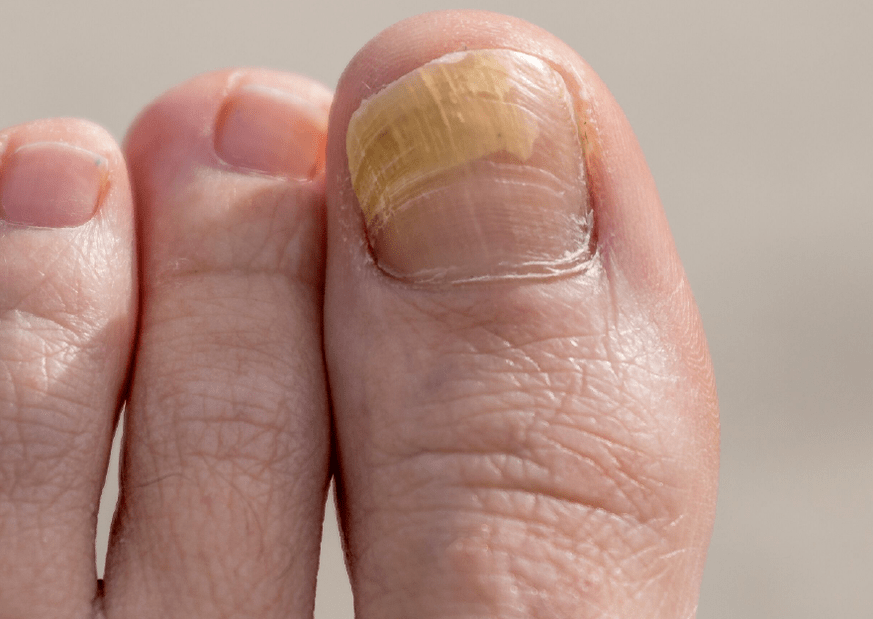 Fungus on the nail of the big toe.