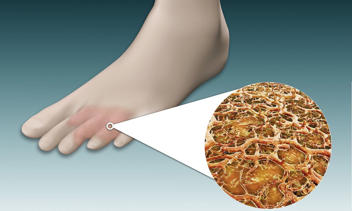 foot fungus spores
