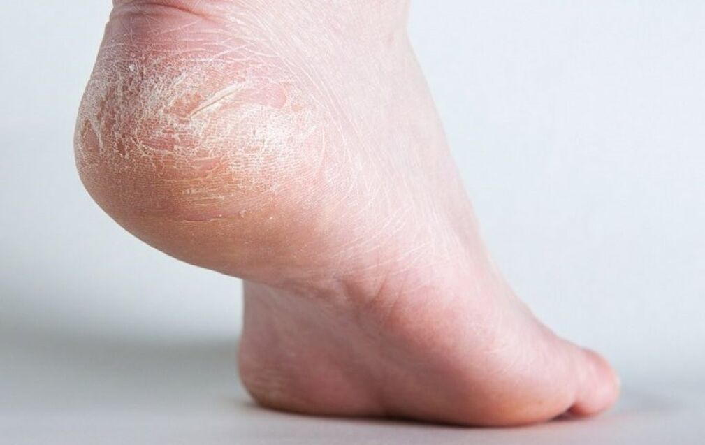 Fungus on the skin of the feet.